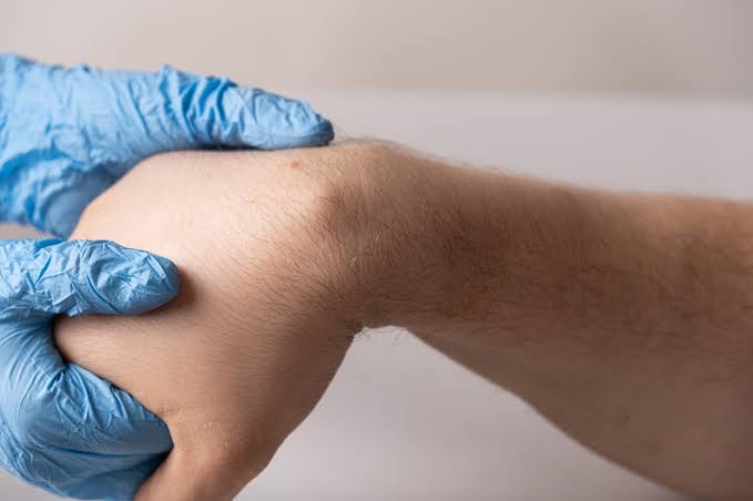 Lipoma Removal